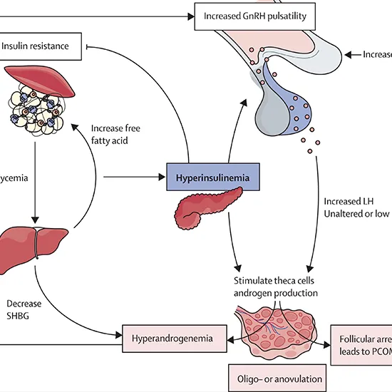 Steroid Panel For Polycystic Ovary Syndrome (PCOS)